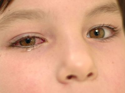 vírusos kötőhártya-gyulladás csökkent látás